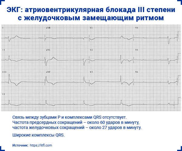 ЭКГ атриовентрикулярная блокада III степени с желудочковым замещающим ритмом
